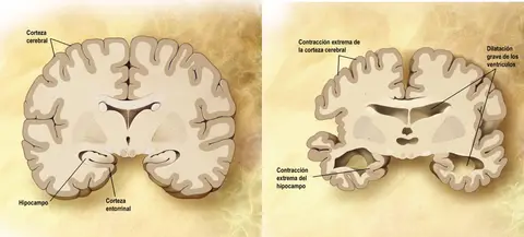 Coín impulsa programa de apoyo al Alzheimer